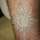 Vanish Laser Tattoo Removal and Skin Aesthetics - 24.10.12