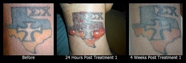 Vanish Laser Tattoo Removal and Skin Aesthetics - 26.09.14